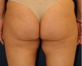 Feel Beautiful - Liposuction Inner Thighs 204 - Before Photo